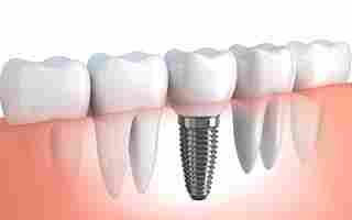 Dental Implants at Hudson Dental Center West New York