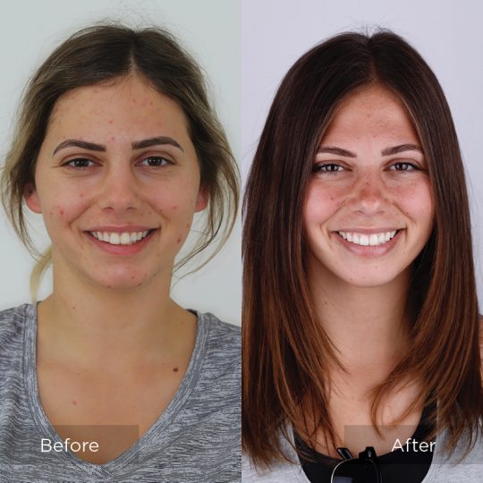 Invisalign After Before Case 1