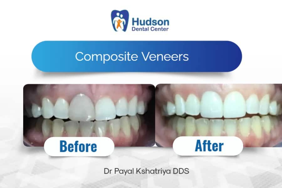 Smile Gallery - Veneers - Before & After